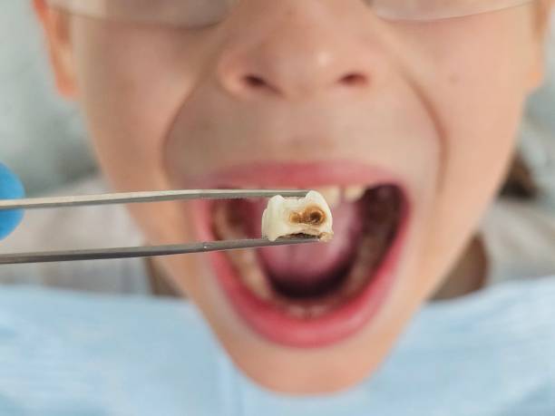 Best Emergency Treatment for Dental Infections or Abscesses in Mcminnville, OR